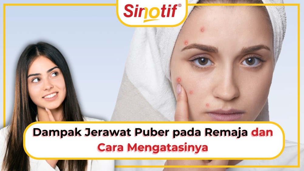 Dampak Jerawat Puber pada Remaja dan Cara Mengatasinya